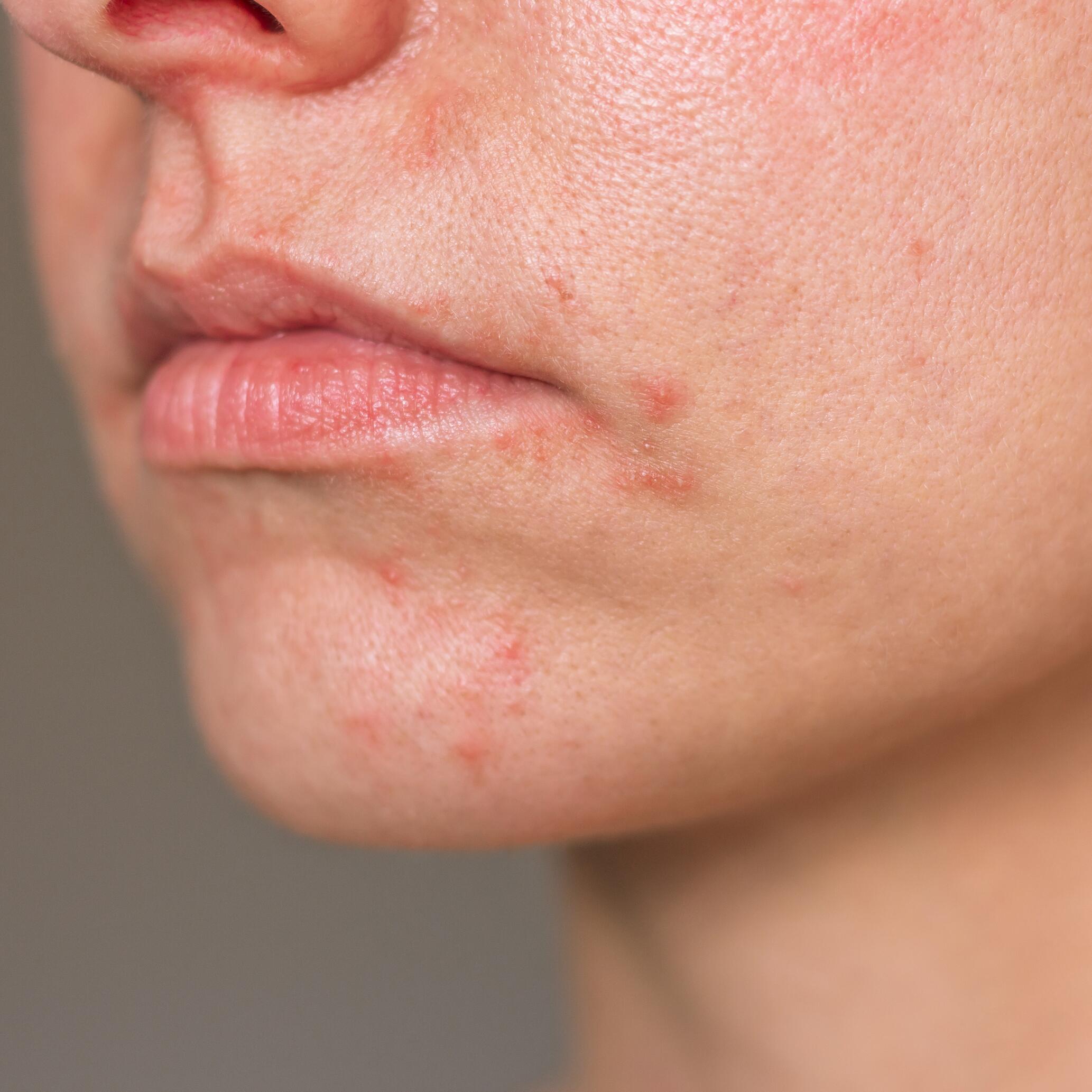 dermite periorale boutons autour de la bouche